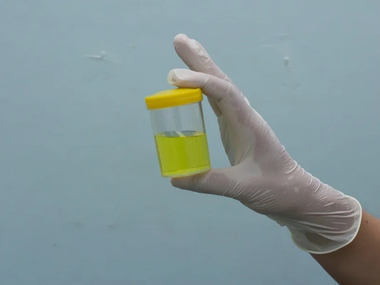 Can a urine test detect STDs? | STDWatch.com
